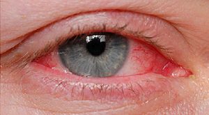 Göz kanlanması neden olur, Göz kanlanmasının tedavisi, Göz kanlanmasının nedenleri