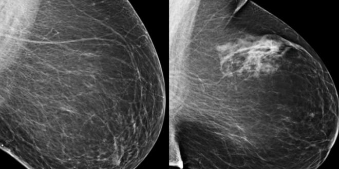 mamografi nedir nasil cekilir doktorumnedio